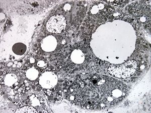 M,14y. | steatosis M,14y. | steatosis